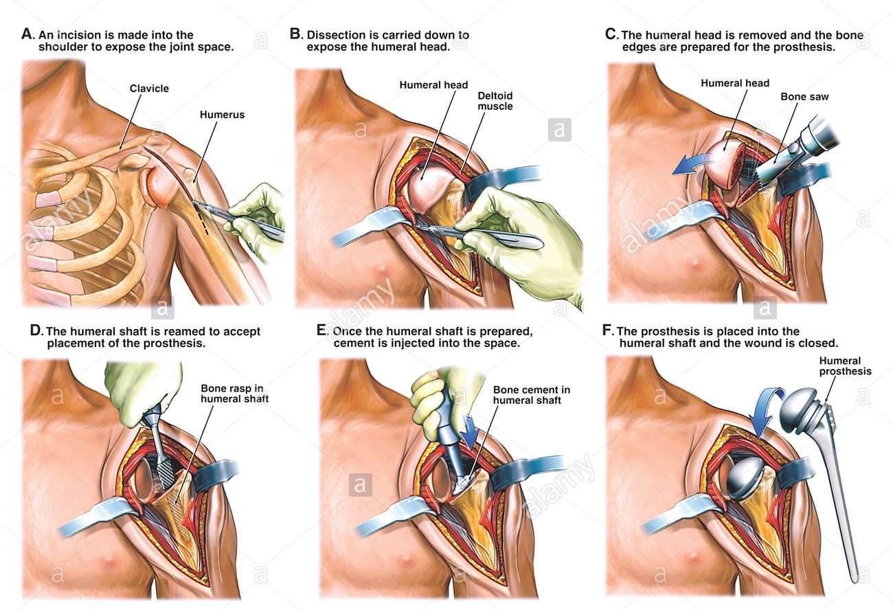 Why Is Shoulder Replacement Recommended ?